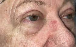 Eyelid Lift (Blepharoplasty/Ptosis Repair)