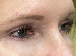 Combination Surgeries (eyelid lift and other)