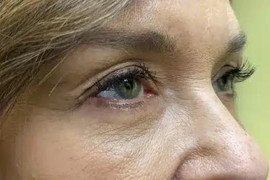 Lower Lid Blepharoplasty (lower eyelid eyelift)