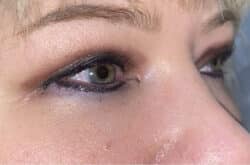 Upper Lid Blepharoplasty (upper eyelid lift)