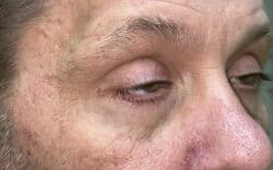 Eyelid Lift (Blepharoplasty/Ptosis Repair)