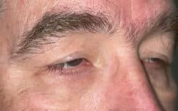 Eyelid Lift (Blepharoplasty/Ptosis Repair)