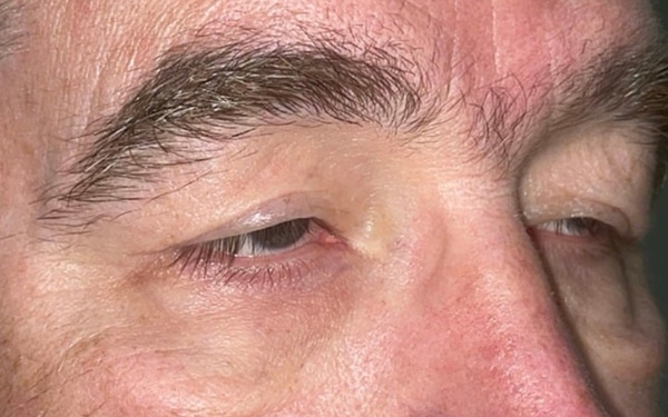 Eyelid Lift (Blepharoplasty/Ptosis Repair)