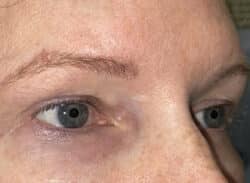 Combination Surgeries (eyelid lift and other)