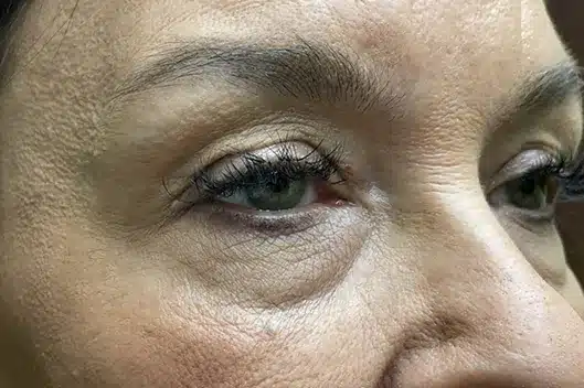 Lower Lid Blepharoplasty (lower eyelid eyelift)