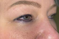Upper Lid Blepharoplasty (upper eyelid lift)