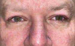 Eyelid Lift (Blepharoplasty/Ptosis Repair)