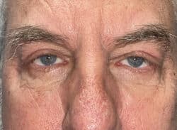 Combination Surgeries (eyelid lift and other)