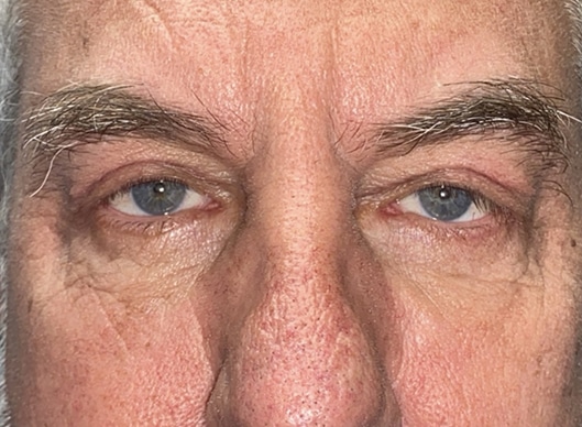 Combination Surgeries (eyelid lift and other)