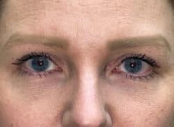 Combination Surgeries (eyelid lift and other)