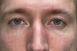 Upper Lid Blepharoplasty (upper eyelid lift)