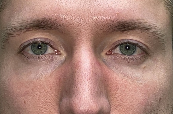 Upper Lid Blepharoplasty (upper eyelid lift)