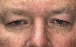Eyelid Lift (Blepharoplasty/Ptosis Repair)