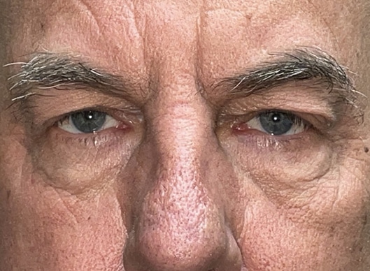 Combination Surgeries (eyelid lift and other)