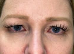 Combination Surgeries (eyelid lift and other)