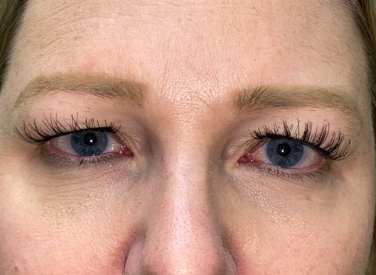 Combination Surgeries (eyelid lift and other)