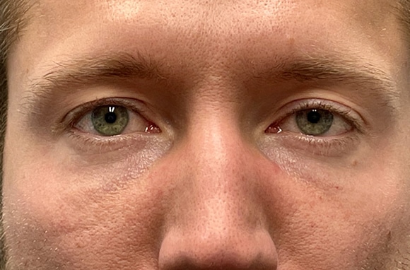 Upper Lid Blepharoplasty (upper eyelid lift)