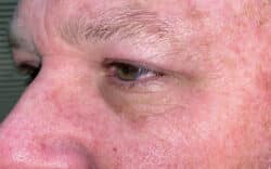 Eyelid Lift (Blepharoplasty/Ptosis Repair)