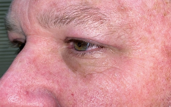 Eyelid Lift (Blepharoplasty/Ptosis Repair)