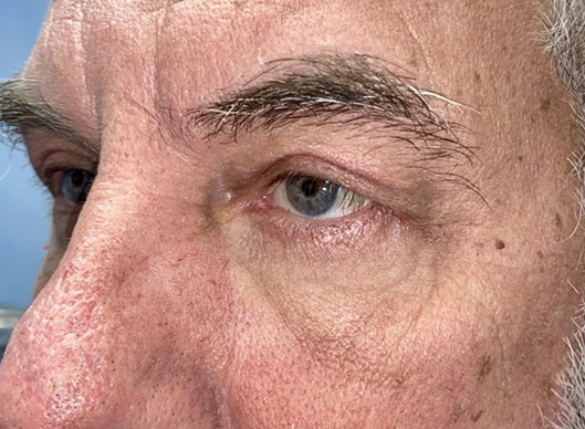 Combination Surgeries (eyelid lift and other)