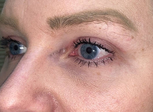 Combination Surgeries (eyelid lift and other)