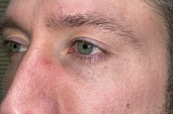 Upper Lid Blepharoplasty (upper eyelid lift)