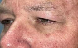 Eyelid Lift (Blepharoplasty/Ptosis Repair)
