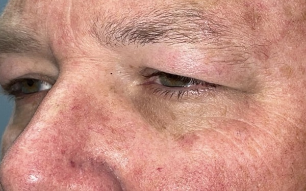Eyelid Lift (Blepharoplasty/Ptosis Repair)