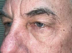 Combination Surgeries (eyelid lift and other)