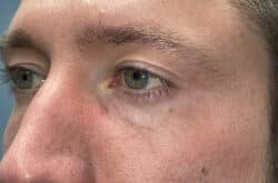 Upper Lid Blepharoplasty (upper eyelid lift)