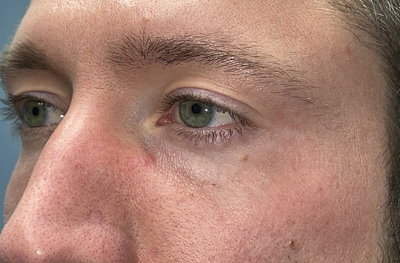 Upper Lid Blepharoplasty (upper eyelid lift)