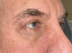 Combination Surgeries (eyelid lift and other)