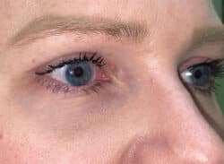 Combination Surgeries (eyelid lift and other)