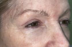 Upper Lid Blepharoplasty (upper eyelid lift)