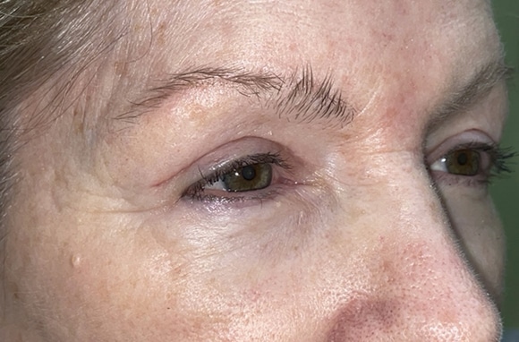 Upper Lid Blepharoplasty (upper eyelid lift)
