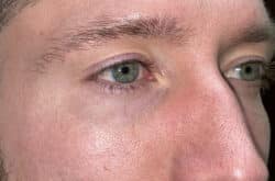 Upper Lid Blepharoplasty (upper eyelid lift)