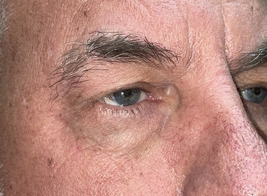 Combination Surgeries (eyelid lift and other)