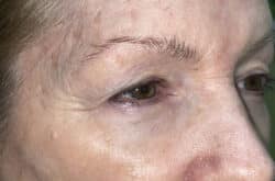 Upper Lid Blepharoplasty (upper eyelid lift)
