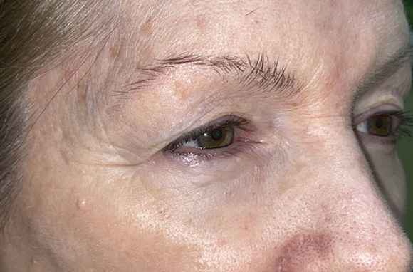Upper Lid Blepharoplasty (upper eyelid lift)