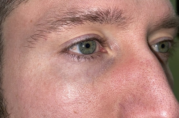 Upper Lid Blepharoplasty (upper eyelid lift)