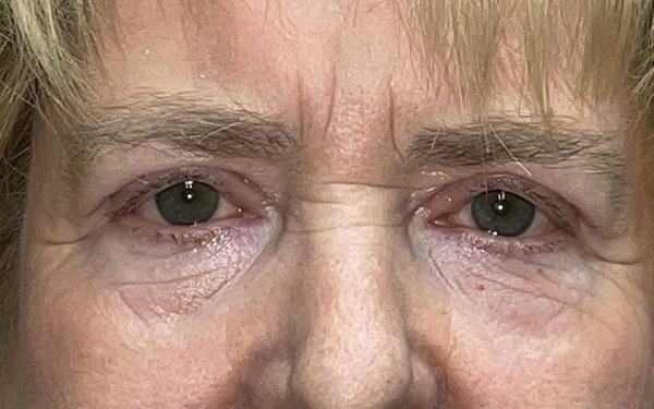 Eyelid Lift (Blepharoplasty/Ptosis Repair)