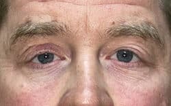 Eyelid Lift (Blepharoplasty/Ptosis Repair)