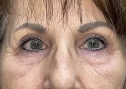 Brow/Forehead Lift