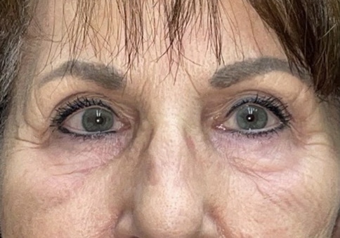 Brow/Forehead Lift