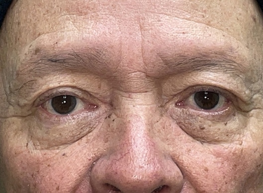 Combination Surgeries (eyelid lift and other)