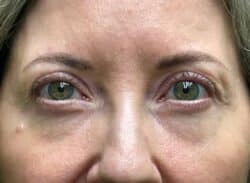 Combination Surgeries (eyelid lift and other)