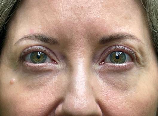 Combination Surgeries (eyelid lift and other)