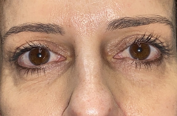 Upper Lid Blepharoplasty (upper eyelid lift)