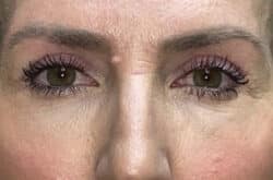 Upper Lid Blepharoplasty (upper eyelid lift)