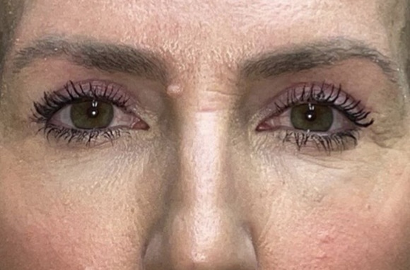 Upper Lid Blepharoplasty (upper eyelid lift)